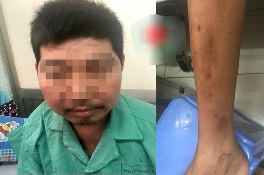 Uống thuốc Đông y ngậm corticoid, người đàn ông to không đều - Ảnh 1.