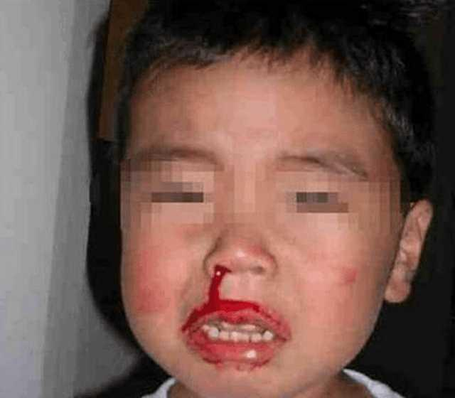 Cảnh báo: Trẻ bị chảy máu cam có thể nguy hiểm tính mạng nếu cứ ngửa đầu ra sau - Ảnh 2.