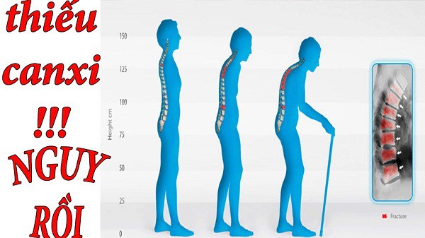 Bác sĩ xương khớp cảnh báo: Nhiều người Việt mắc chứng bệnh này xương chẳng khác gì gỗ mục - Ảnh 2.