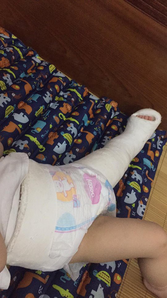 Tưởng chỉ bị đau chân bình thường, ai ngờ bé 10 tháng tuổi mắc phải căn bệnh lạ ở trẻ em - Ảnh 4.