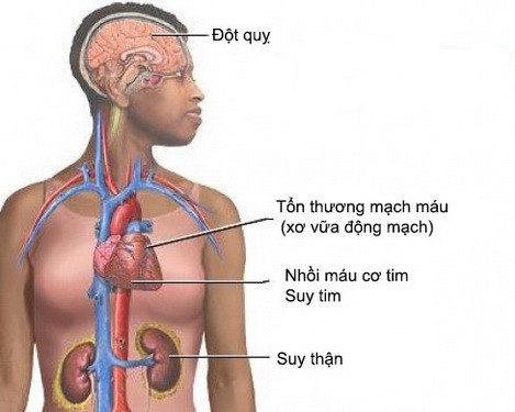 Tăng huyết áp và bệnh tim mạch ở người cao tuổi - Ảnh 1.