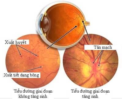 Tim mạch - Nội tiết - Máu - Những bệnh lý liên quan đến mắt không thể chủ quan - Ảnh 8.