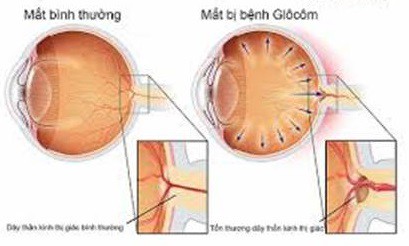 Tim mạch - Nội tiết - Máu - Những bệnh lý liên quan đến mắt không thể chủ quan - Ảnh 10.