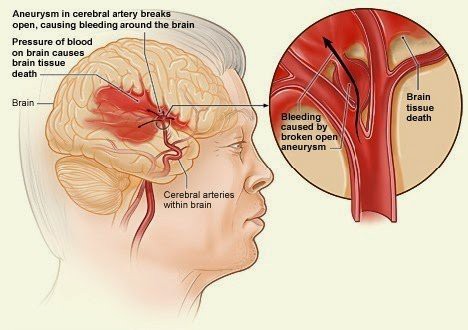 Đột quỵ hay xảy ra vào sáng sớm: Dừng ngay thói quen này để chặn đứng nguy cơ - Ảnh 2.