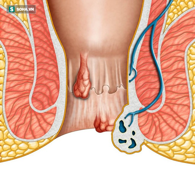 6 dấu hiệu sớm và thường gặp của bệnh ung thư hậu môn: Nếu có, bạn hãy đi khám ngay - Ảnh 2.