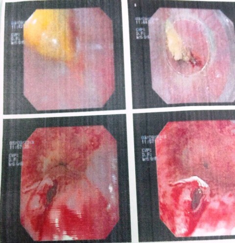 Hóc xương gà, thủng thực quản vì lớn tiếng với con - Ảnh 1.