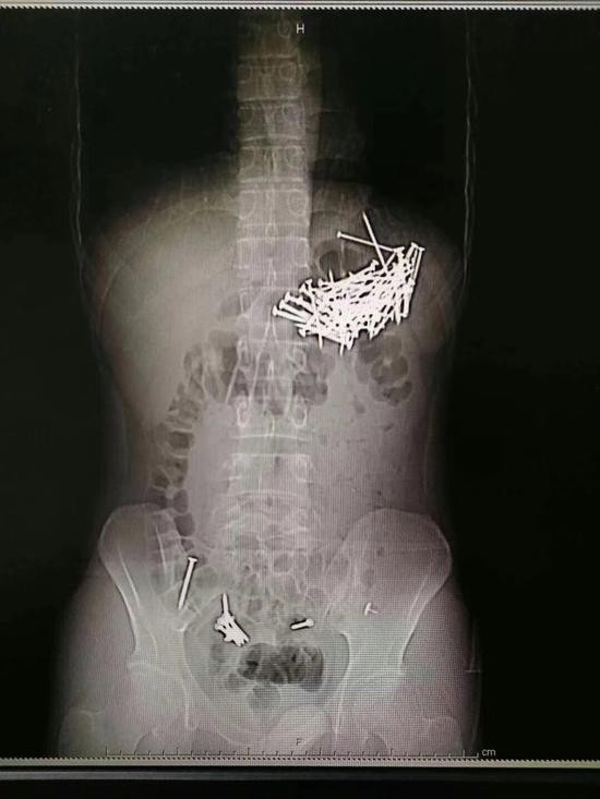 Trung Quốc: Nhập viện vì đau bụng dữ dội, bác sĩ phát hiện bệnh nhân đã nuốt đến 87 cây đinh sắt - Ảnh 1.