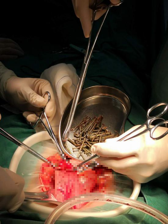 Trung Quốc: Nhập viện vì đau bụng dữ dội, bác sĩ phát hiện bệnh nhân đã nuốt đến 87 cây đinh sắt - Ảnh 2.