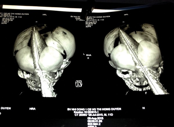 “Cậu bé bị đâm xuyên sọ” khỏe mạnh tuổi lên 3 - Ảnh 2.