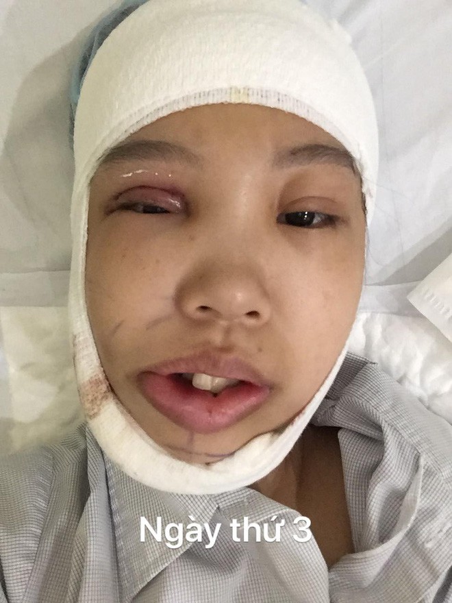 Bị bạn bè trêu chọc vì teo nửa bên mặt, cô gái Hà Nội lột xác sau phẫu thuật thẩm mỹ - Ảnh 3.