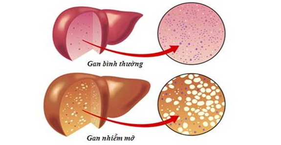 Sống khỏe với gan nhiễm mỡ nhiều năm, không khó! - Ảnh 1.