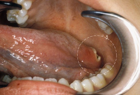 10 bệnh thường gặp ở miệng: Cái số 5 và 6 có thể biến thành ung thư, ai cũng nên cảnh giác - Ảnh 8.