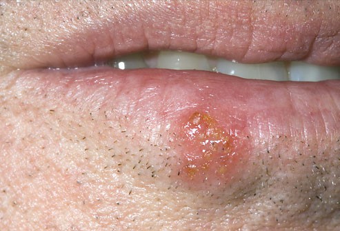 10 bệnh thường gặp ở miệng: Cái số 5 và 6 có thể biến thành ung thư, ai cũng nên cảnh giác - Ảnh 1.