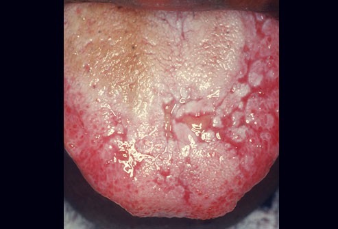 10 bệnh thường gặp ở miệng: Cái số 5 và 6 có thể biến thành ung thư, ai cũng nên cảnh giác - Ảnh 6.