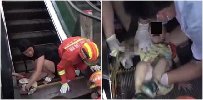 Không cẩn thận khi đi thang cuốn, bé 1 tuổi bị nuốt trọn cánh tay trong vụ tai nạn kinh hoàng - Ảnh 2.