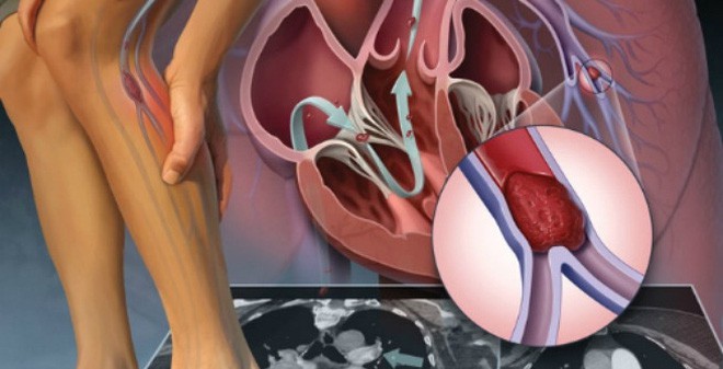 Đừng đùa với những đường gân loằng ngoằng, không cẩn thận có thể biến chứng vào tim, phổi - Ảnh 2.