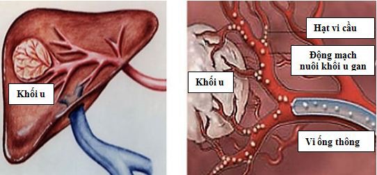 Ung thư gan trị thế nào? - Ảnh 2.