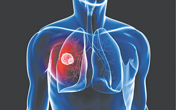 Làm sao phát hiện sớm ung thư phổi? - Ảnh 1.