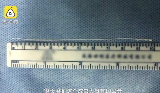 Trung Quốc: Sán dây dài 10 cm chui vào não thanh niên mê đồ nướng - Ảnh 2.