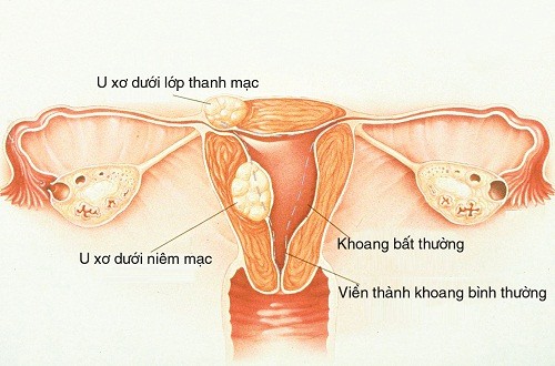 Bác sĩ BV Phụ Sản chỉ rõ nguyên nhân sẩy thai liên tiếp các mẹ cần chú ý - Ảnh 1.