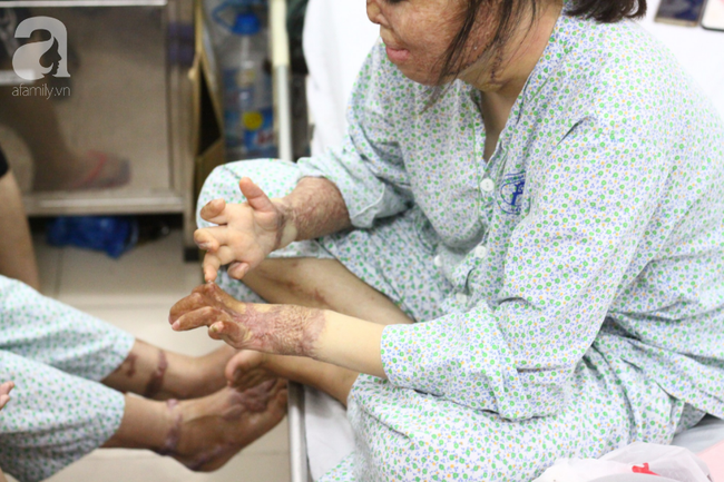 Sau 1 năm và hàng chục cuộc phẫu thuật, người vợ Hà Nội bị chồng thiêu hôm mùng 2 Tết, chỉ có 1% cơ hội sống sót đã hồi sinh - Ảnh 11.