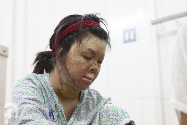 Sau 1 năm và hàng chục cuộc phẫu thuật, người vợ Hà Nội bị chồng thiêu hôm mùng 2 Tết, chỉ có 1% cơ hội sống sót đã hồi sinh - Ảnh 10.