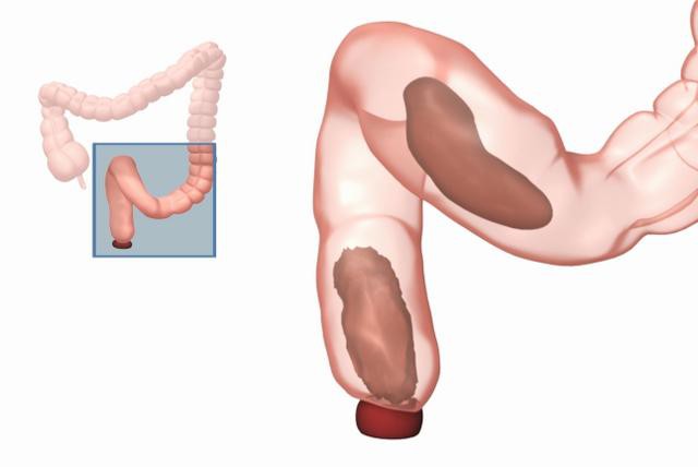 BS cảnh báo: Căn bệnh khó nói đang âm thầm tấn công sức khỏe giới văn phòng - Ảnh 2.