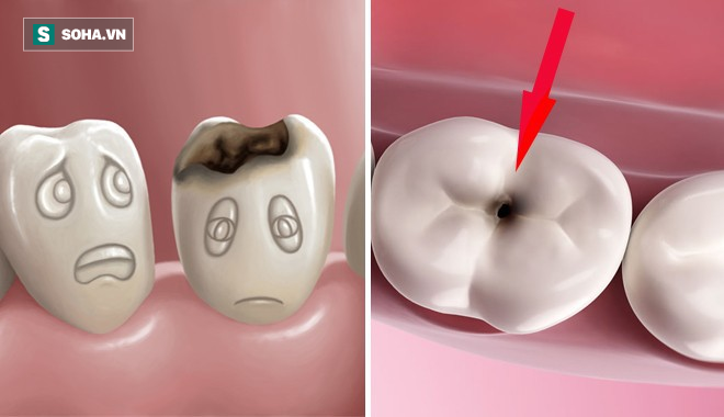 Chuyện gì sẽ xảy ra nếu bạn có một chiếc răng sâu và không chịu chữa trị ngay? - Ảnh 1.