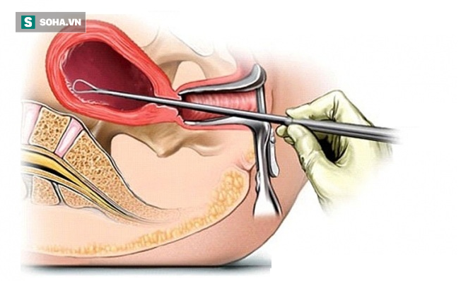 Tắc kinh và đau bụng kèm ra máu: BS sản khoa cảnh báo nguy cơ khiến chị em vô sinh - Ảnh 3.