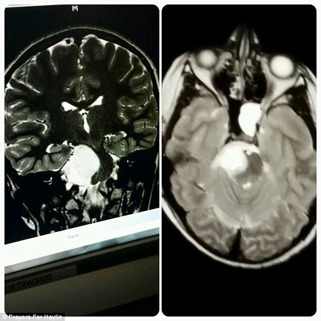 Tưởng là đau đầu thông thường, cô gái 14 tuổi được chẩn đoán có một khối u trong não - Ảnh 2.