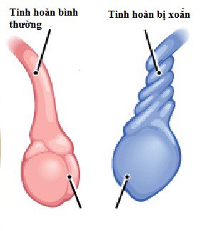 Suy tinh hoàn dễ gây vô sinh - Ảnh 1.