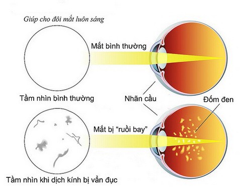 Bỗng dưng có “ruồi bay” trước mắt: Nguy hiểm thế nào? - Ảnh 1.