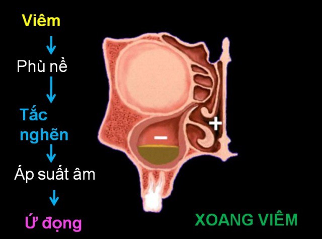 Viêm mũi xoang không điều trị dễ gây biến chứng não, thậm chí tử vong - Ảnh 3.