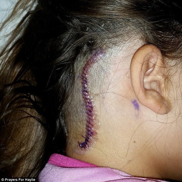 Tưởng là đau đầu thông thường, cô gái 14 tuổi được chẩn đoán có một khối u trong não - Ảnh 3.