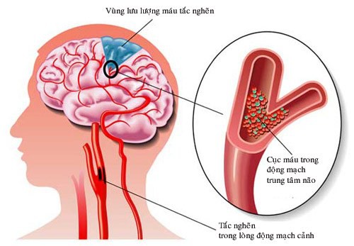 Chuyên gia Đông y mách bài thuốc chữa tăng huyết áp cực kỳ đơn giản mà hiệu quả - Ảnh 3.