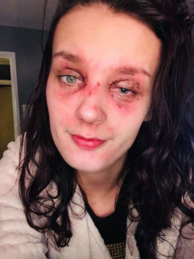 Thiếu nữ trẻ bị bỏng mắt, suy giảm thị lực vì quả trứng luộc phát nổ và lời cảnh báo tới tất cả chúng ta - Ảnh 3. Thiếu nữ trẻ bị bỏng mắt, suy giảm thị lực vì quả trứng luộc phát nổ và lời cảnh báo tới tất cả chúng ta - Ảnh 3.