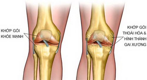 Bí quyết giúp hỗ trợ giảm đau nhức xương khớp khi trời lạnh - Ảnh 1.