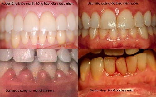 Bài thuốc hay trị chảy máu mũi, chảy máu chân răng - Ảnh 1.