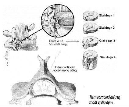 Thoát vị đĩa đệm: Thận trọng khi sử dụng thuốc chống viêm - Ảnh 1.