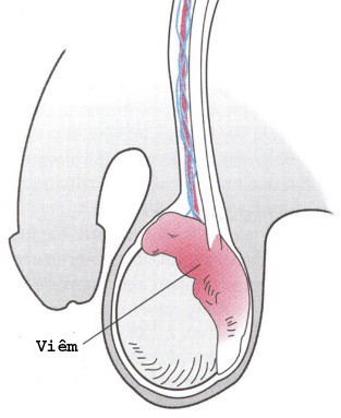 Viêm mào tinh hoàn - bệnh lý liên quan đến vô sinh ở nam giới - Ảnh 1.