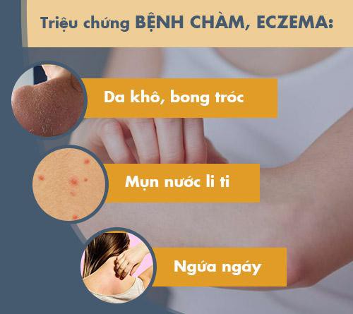 Bệnh chàm eczema: Dấu hiệu và cách chữa chặn đứng nguy cơ tái phát - Ảnh 1.
