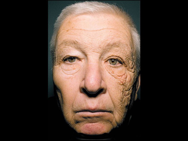 Nhìn những hình ảnh này mới thấy chính xác những thiệt hại của ánh nắng mặt trời gây ra cho làn da của bạn - Ảnh 2.