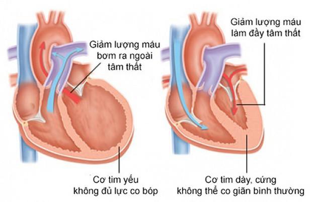 Suy tim vẫn có thể sống khỏe mạnh nếu duy trì những thói quen tốt sau - Ảnh 1.