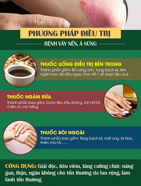 Cách chữa vảy nến, á sừng hiệu quả theo tư vấn bác sĩ trưởng khoa da liễu - Ảnh 1.