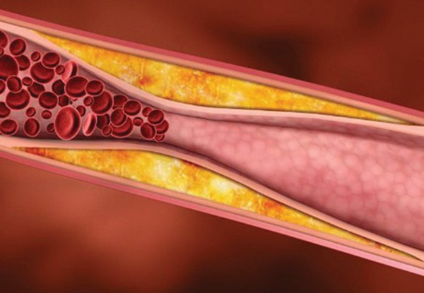 Nguy cơ gây đột quỵ do mỡ máu tăng cao - Ảnh 2.