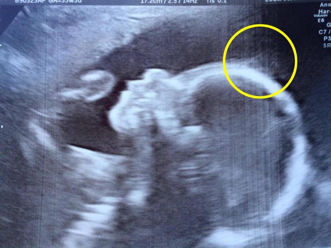 Mẹ lo sợ thấy dấu hiệu lạ trên đầu thai khi siêu âm, không ngờ con chào đời đã nổi tiếng, ngàn người hâm mộ - Ảnh 1.