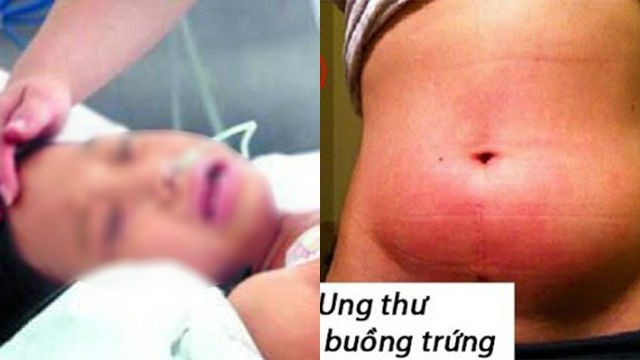 Ám ảnh 1 tuần phát hiện 3 bé mắc ung thư buồng trứng: Dấu hiệu bất thường cha mẹ cần chú ý - Ảnh 1.