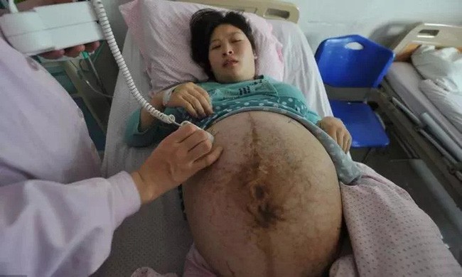 Sản phụ mang thai 3 tháng mà bụng to như cái trống, đến ngày lâm bồn bệnh viện phải huy động toàn bộ bác sĩ giỏi đỡ đẻ - Ảnh 3.