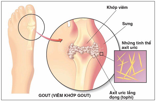 Cách kiểm soát axit uric tăng cao - Ảnh 1.