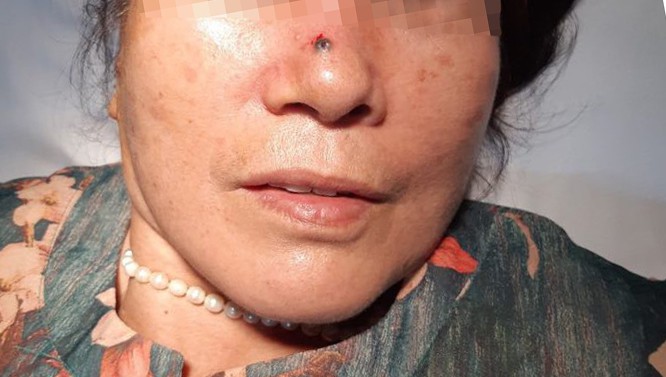 Nốt Ruồi Trên Sống Mũi